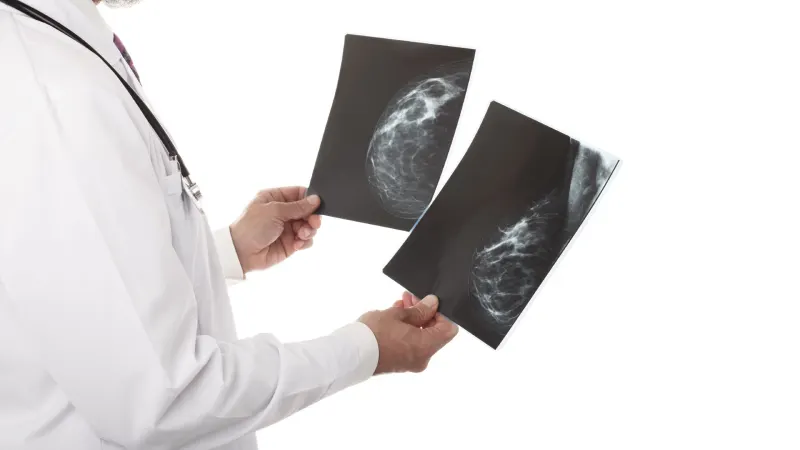 3D Mammography